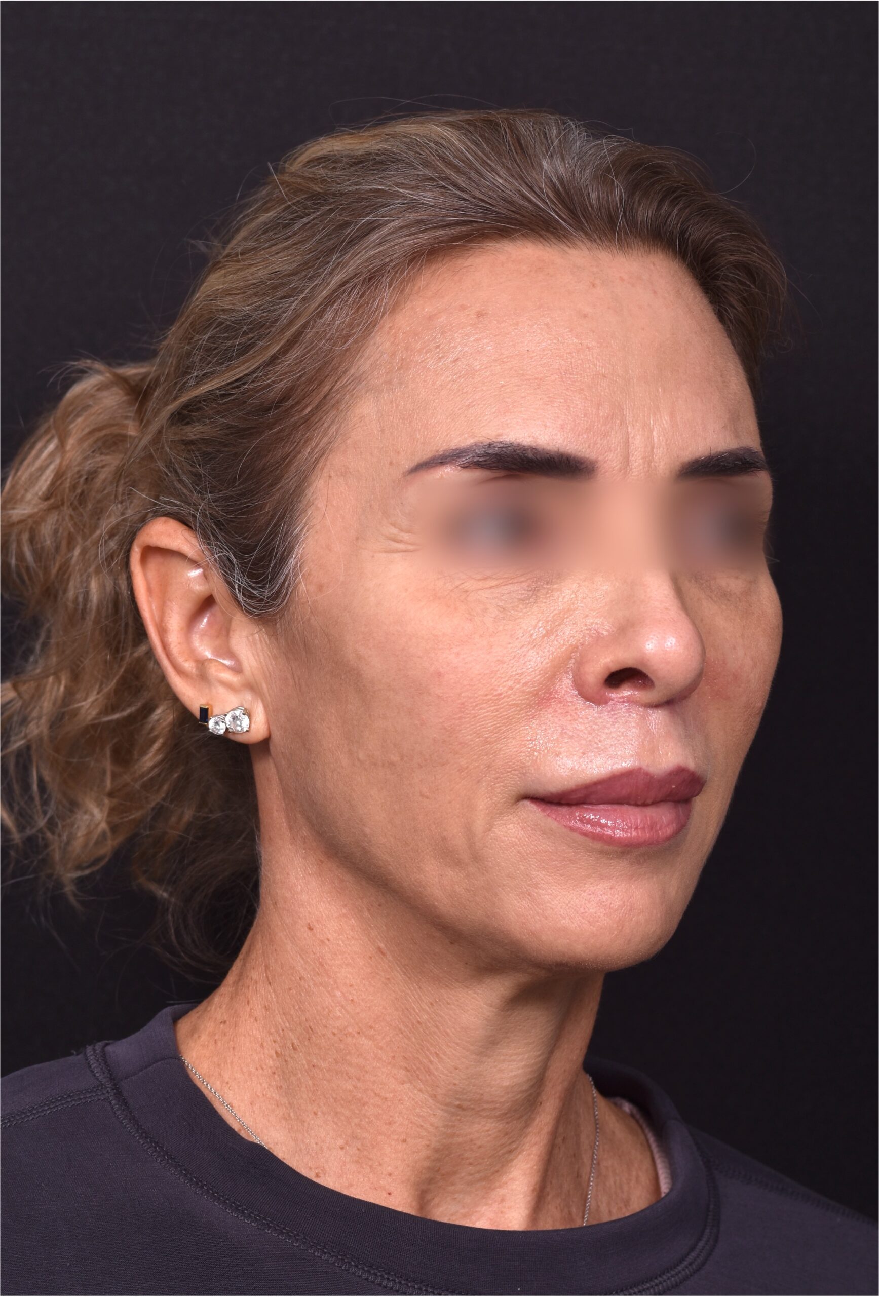 Lip lift surgery best expert near me Atlanta silicone collagen filler scarless