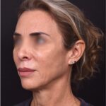 Lip lift surgery best expert near me Atlanta silicone collagen filler scarless