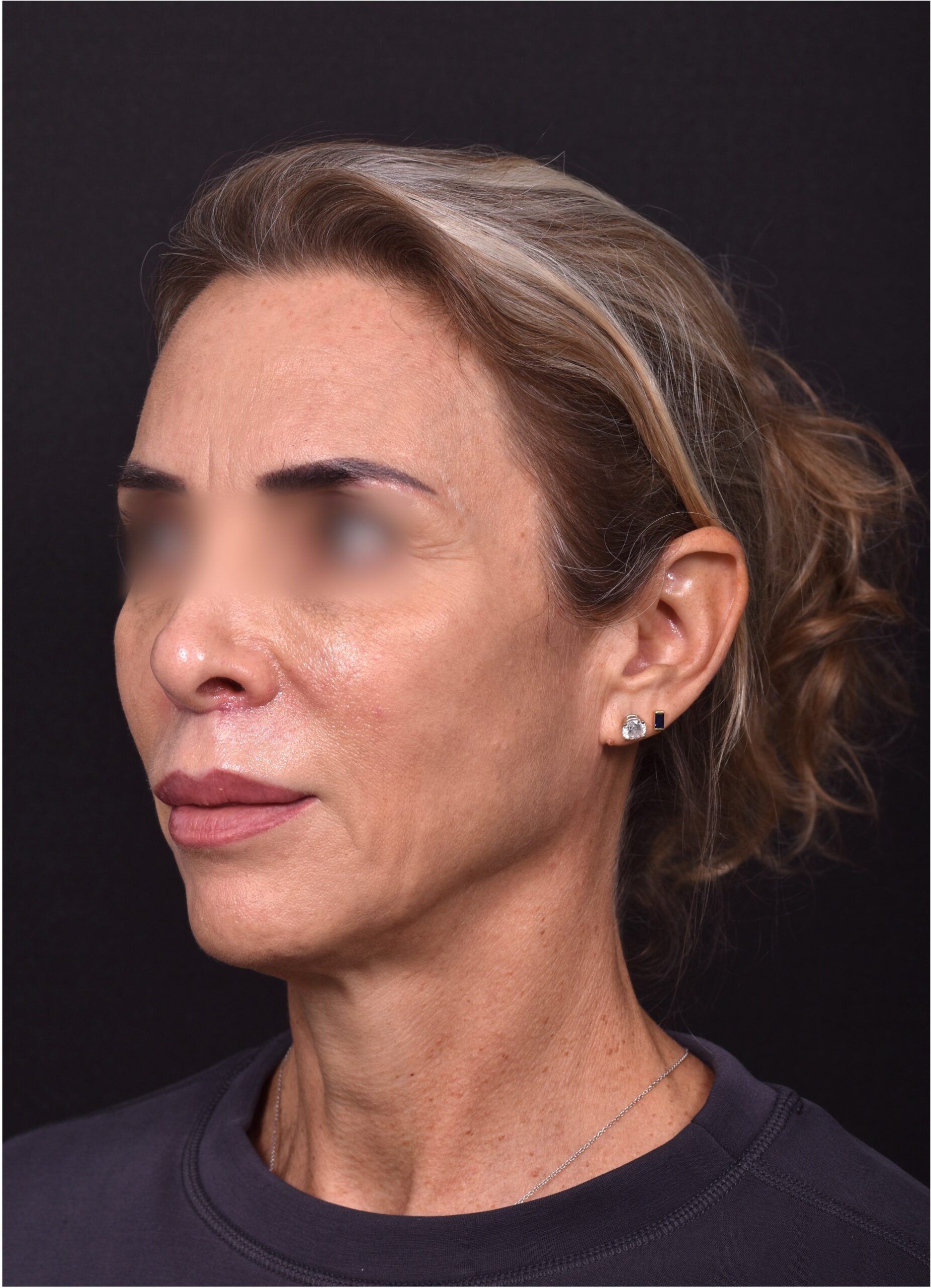 Lip lift surgery best expert near me Atlanta silicone collagen filler scarless