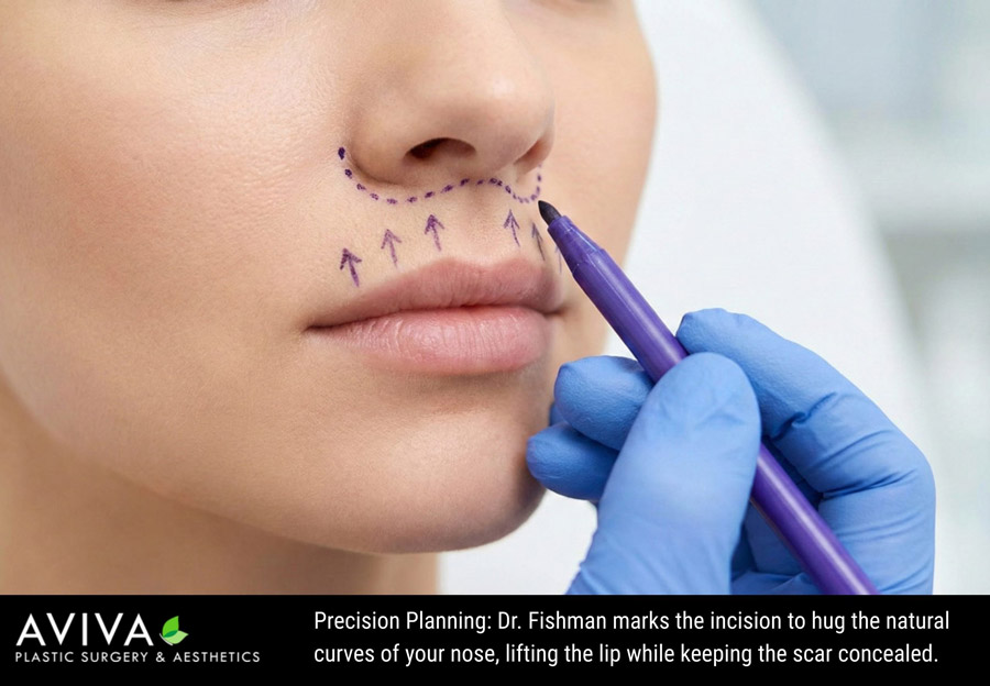 Precision Planning: Dr. Fishman marks the incision to hug the natural curves of your nose, lifting the lip while keeping the scar concealed.