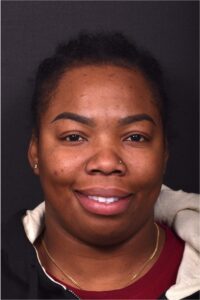 Forehead lipoma bump knot collagen scarless surgery best expert near me Atlanta