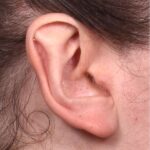 Atlanta otoplasty ear surgery revision earlobe collagen best expert near me before after results