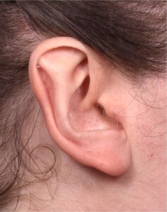 Atlanta otoplasty ear surgery revision earlobe collagen best expert near me before after results