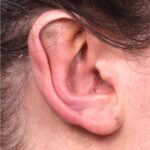 Atlanta otoplasty ear surgery revision earlobe collagen best expert near me before after results