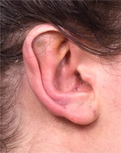 Atlanta otoplasty ear surgery revision earlobe collagen best expert near me before after results