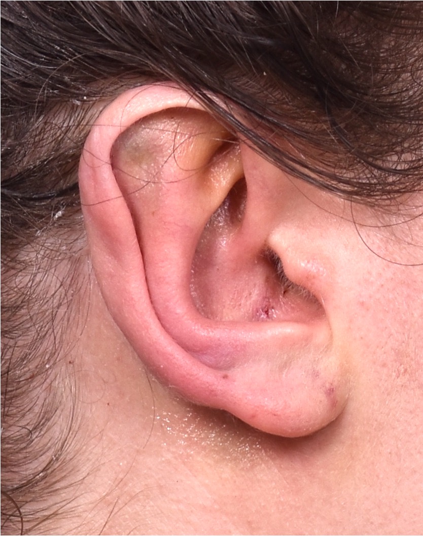 Atlanta otoplasty ear surgery revision earlobe collagen best expert near me before after results