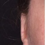 Atlanta otoplasty ear surgery revision earlobe collagen best expert near me before after results