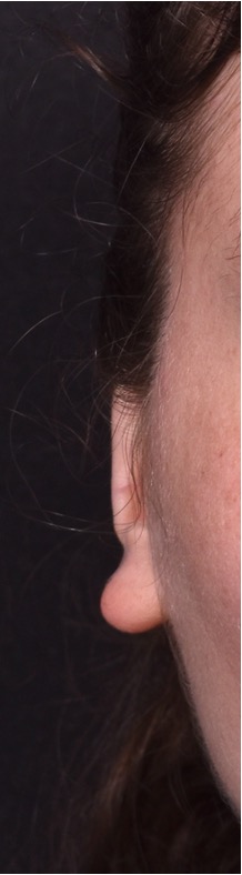 Atlanta otoplasty ear surgery revision earlobe collagen best expert near me before after results