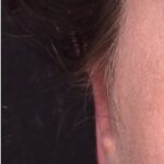 Atlanta otoplasty ear surgery revision earlobe collagen best expert near me before after results