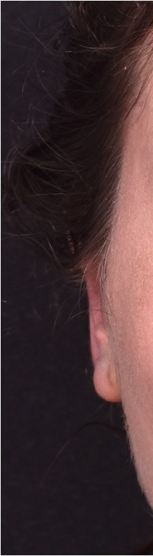 Atlanta otoplasty ear surgery revision earlobe collagen best expert near me before after results