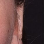 Atlanta otoplasty ear surgery revision earlobe collagen best expert near me before after results