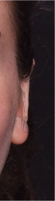 Atlanta otoplasty ear surgery revision earlobe collagen best expert near me before after results