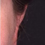 Atlanta otoplasty ear surgery revision earlobe collagen best expert near me before after results
