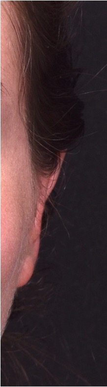 Atlanta otoplasty ear surgery revision earlobe collagen best expert near me before after results