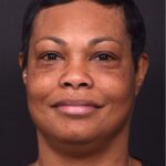 Before forehead osteoma removal in 50-year-old female patient by Dr. Inessa Fishman, Aviva Plastic Surgery Atlanta