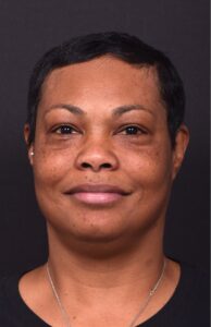 Before forehead osteoma removal in 50-year-old female patient by Dr. Inessa Fishman, Aviva Plastic Surgery Atlanta