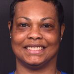 After photo of right lateral forehead osteoma in female patient prior to removal by Dr. Inessa Fishman in Atlanta