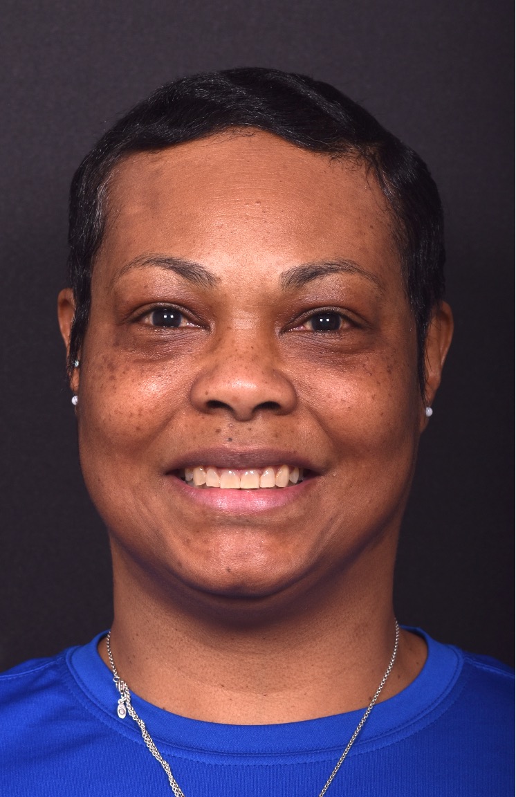 After photo of right lateral forehead osteoma in female patient prior to removal by Dr. Inessa Fishman in Atlanta