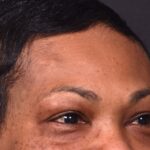 Before photo of right lateral forehead osteoma in female patient prior to removal by Dr. Inessa Fishman in Atlanta