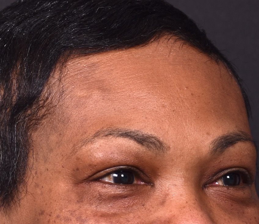 Before photo of right lateral forehead osteoma in female patient prior to removal by Dr. Inessa Fishman in Atlanta