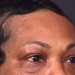 After photo of right lateral forehead osteoma in female patient prior to removal by Dr. Inessa Fishman in Atlanta