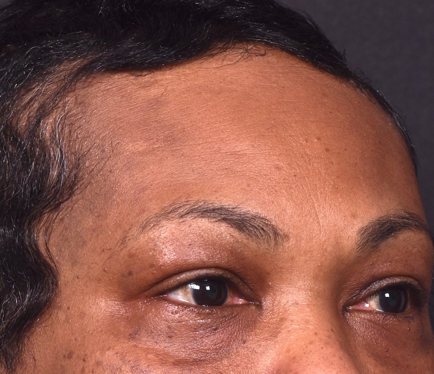 After photo of right lateral forehead osteoma in female patient prior to removal by Dr. Inessa Fishman in Atlanta