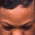 Before photo of right lateral forehead osteoma in female patient prior to removal by Dr. Inessa Fishman in Atlanta