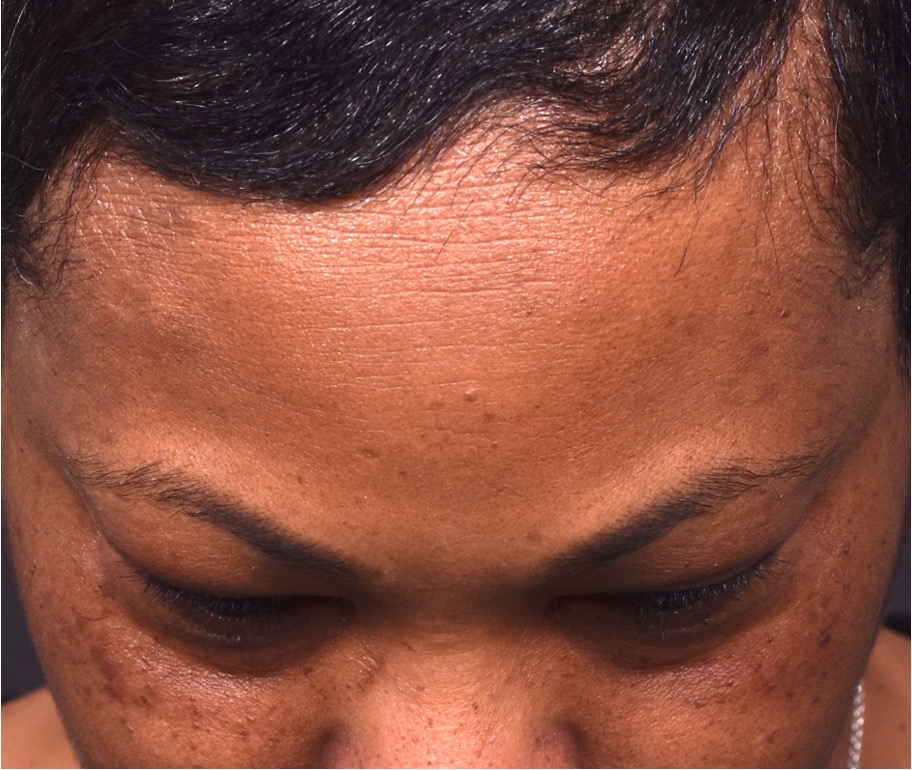 Before photo of right lateral forehead osteoma in female patient prior to removal by Dr. Inessa Fishman in Atlanta