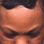 After photo of right lateral forehead osteoma in female patient prior to removal by Dr. Inessa Fishman in Atlanta