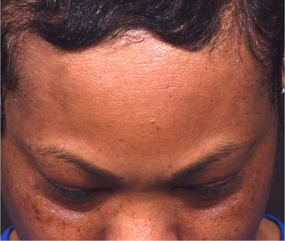 After photo of right lateral forehead osteoma in female patient prior to removal by Dr. Inessa Fishman in Atlanta