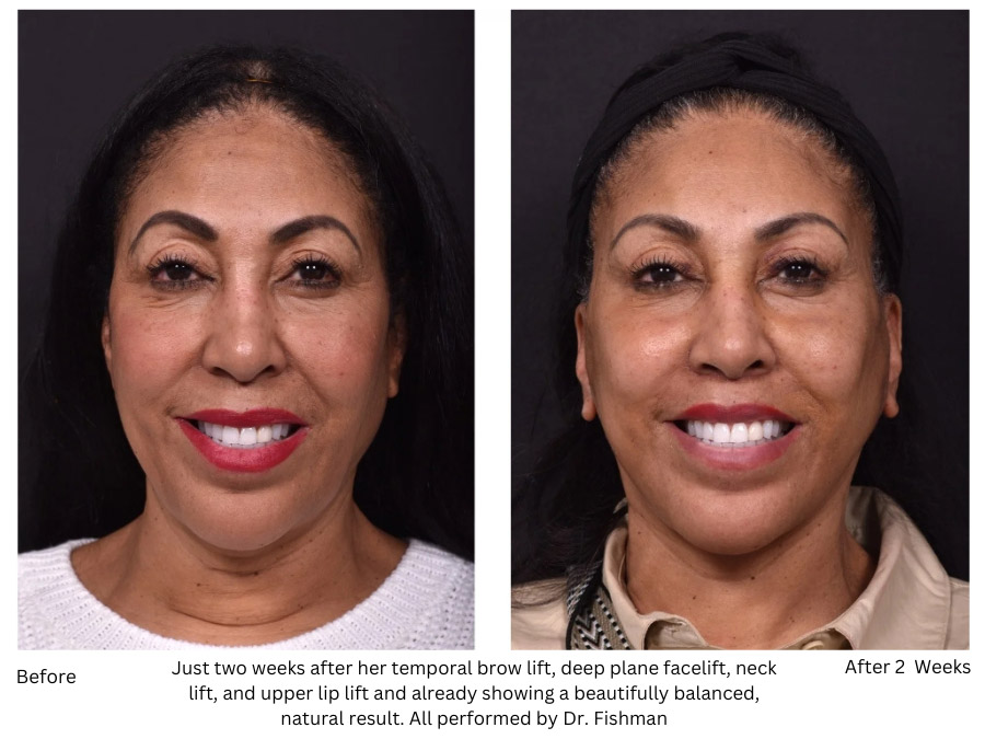Just two weeks after her temporal brow lift, deep plane facelift, neck lift, and upper lip lift and already showing a beautifully balanced, natural result. All performed by Dr. Fishman