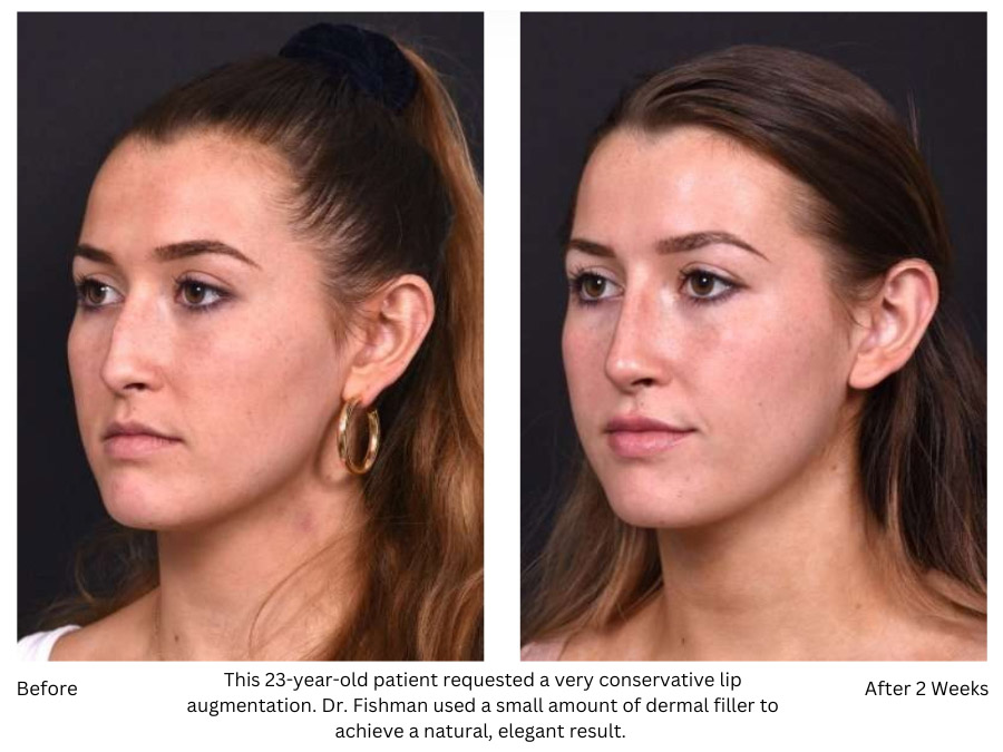 This 23-year-old patient requested a very conservative lip augmentation. Dr. Fishman used a small amount of dermal filler to achieve a natural, elegant result. 