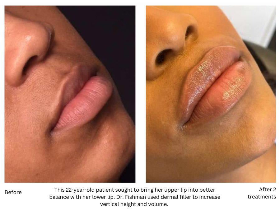 This 22-year-old patient sought to bring her upper lip into better balance with her lower lip. Dr. Fishman used dermal filler to increase vertical height and volume. 