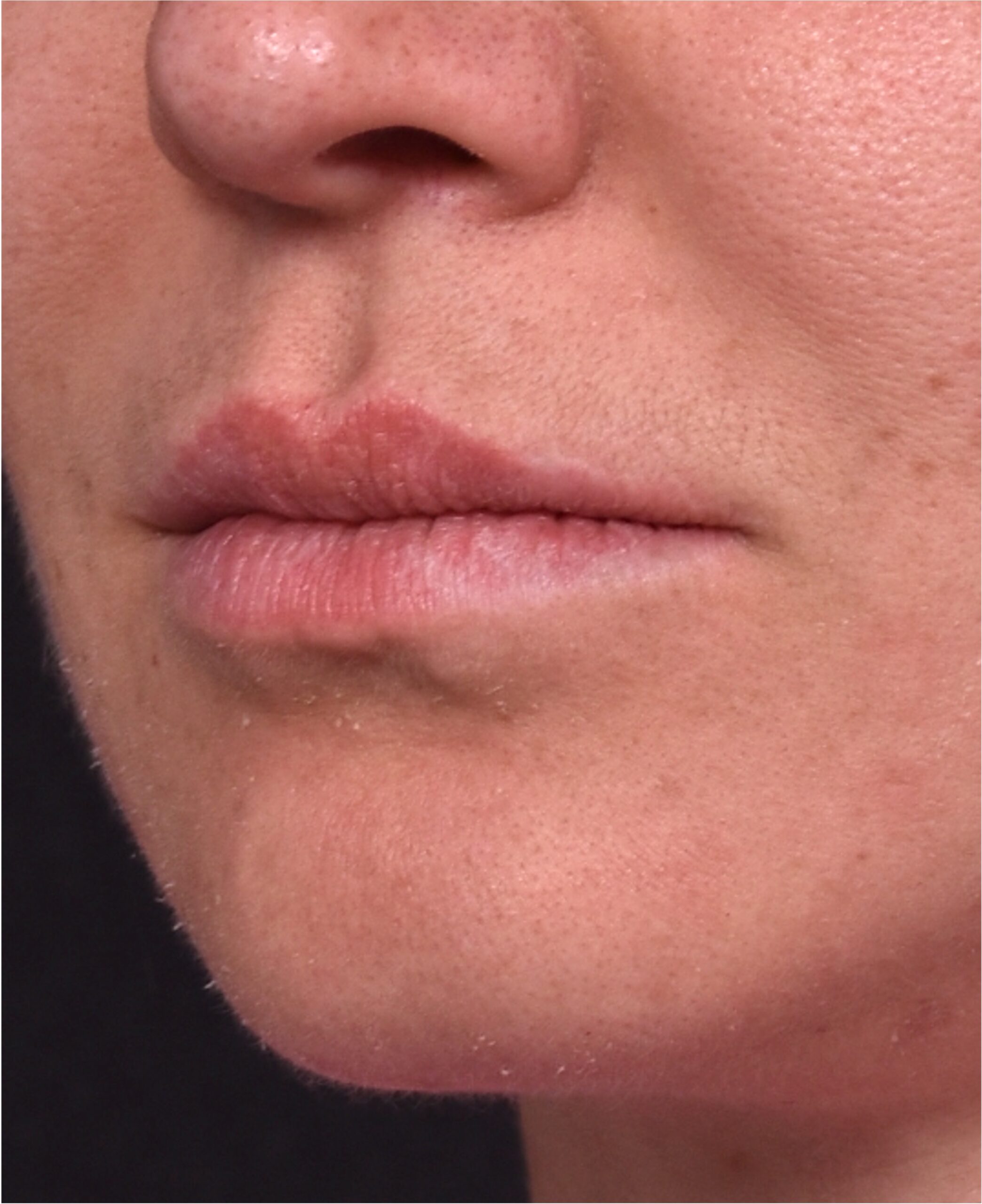 Corner lip lift Atlanta bullhorn before and after collagen skin plastic surgeon