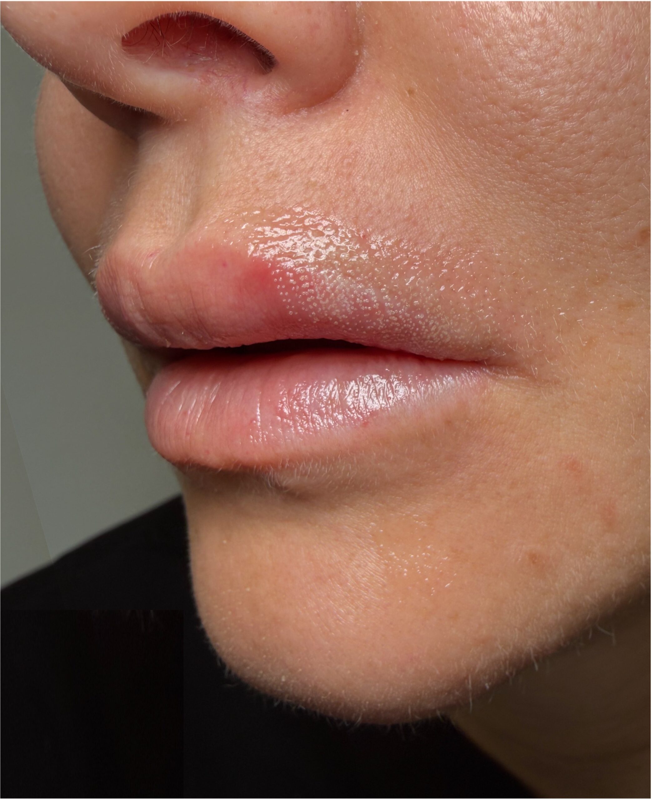Corner lip lift Atlanta bullhorn before and after collagen skin plastic surgeon