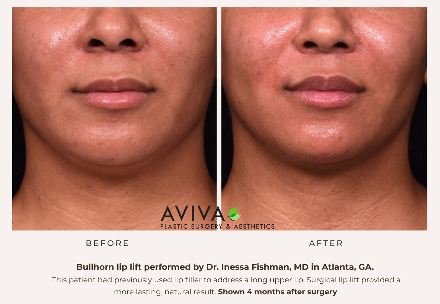 Bullhorn lip lift before and after — Dr. Inessa Fishman MD Atlanta GA