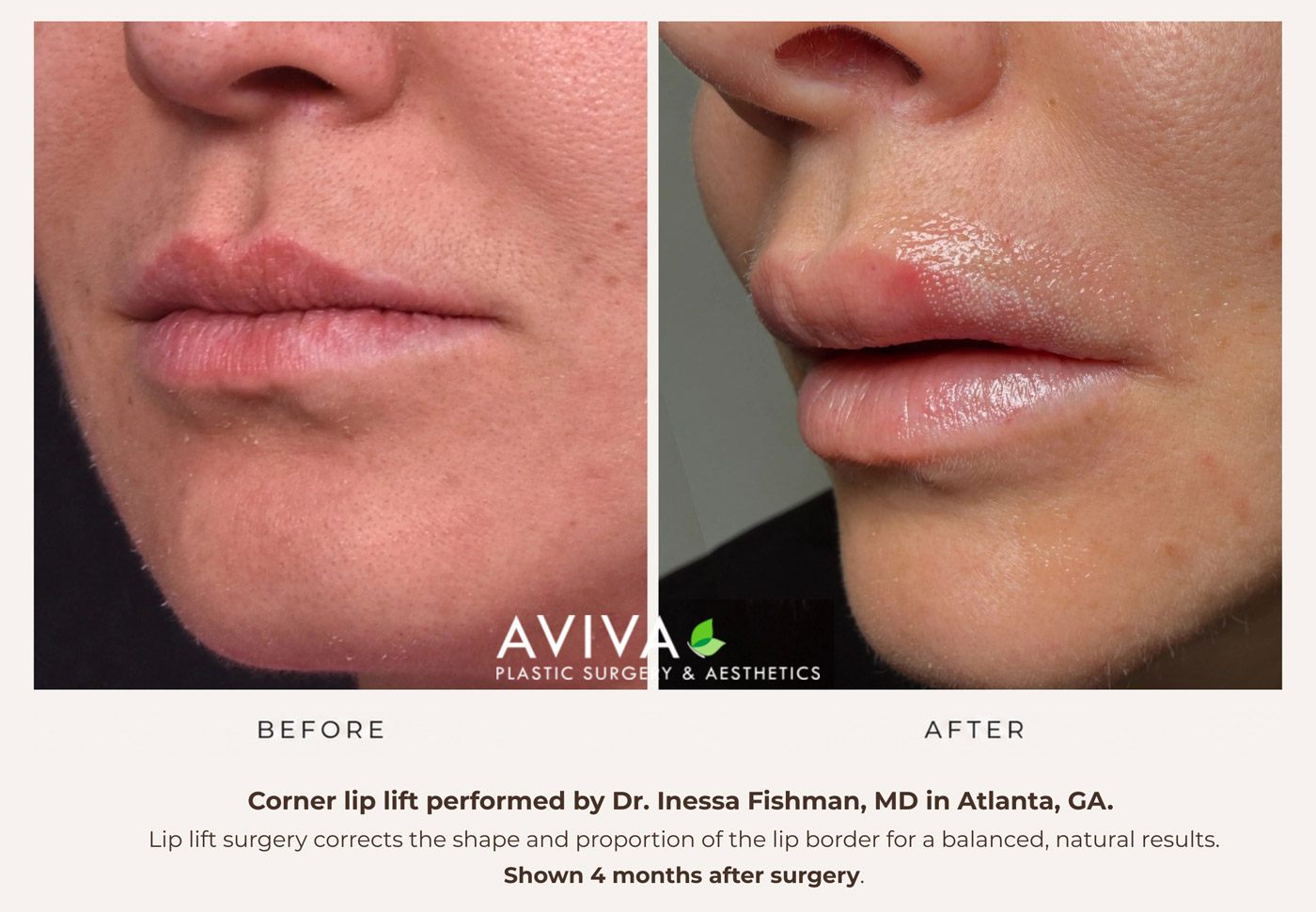 Corner lip lift before and after — Dr. Inessa Fishman MD Atlanta GA