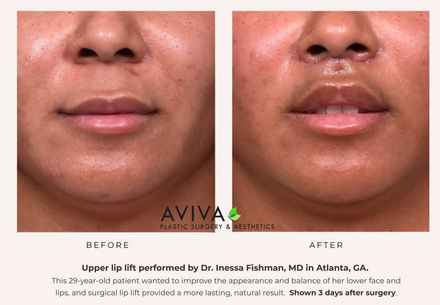 Upper lip lift before and after Dr. Inessa Fishman MD Atlanta GA 3 days post surgery