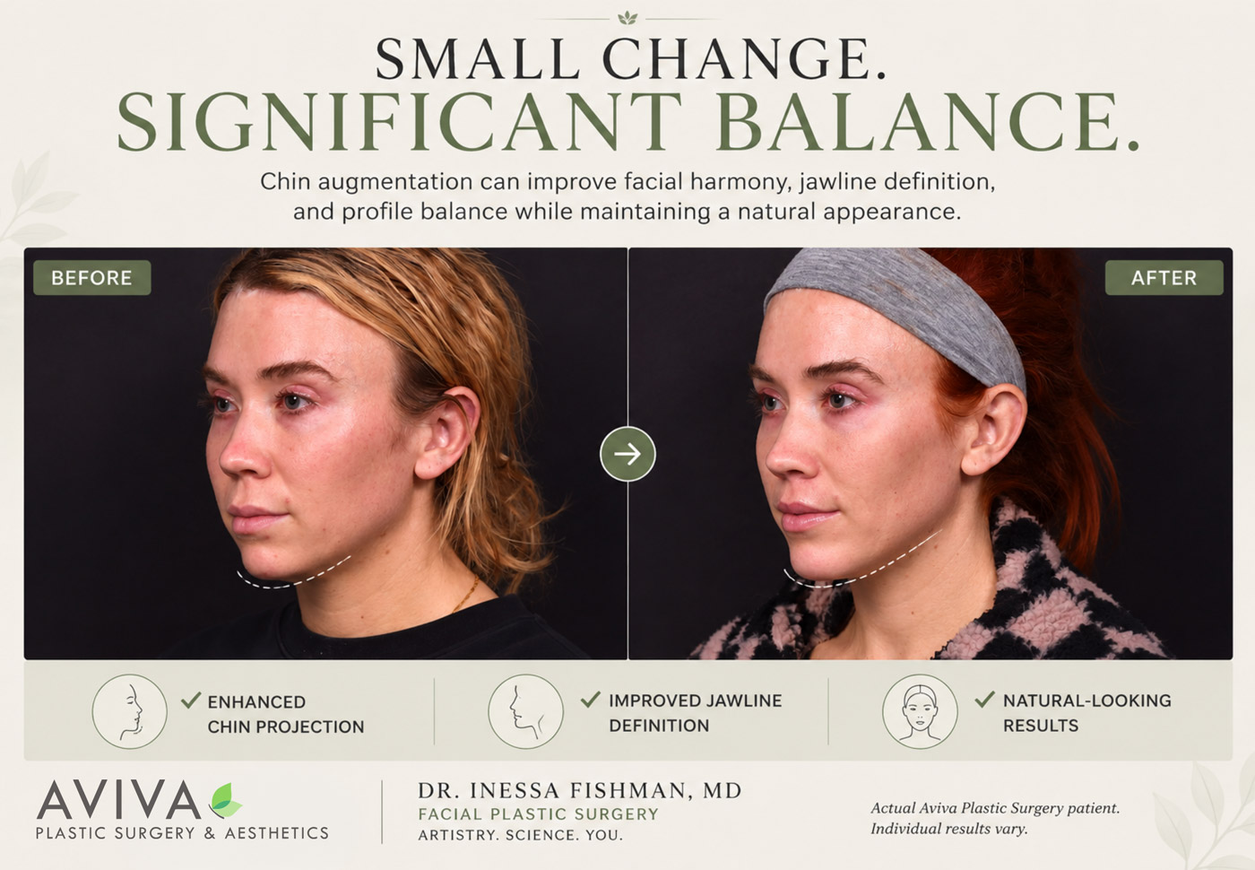 Chin augmentation before and after — Small Change, Significant Balance — Dr. Inessa Fishman MD Aviva Plastic Surgery Atlanta
