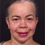 Forehead reduction hairline lowering surgery best expert near me collagen Atlanta