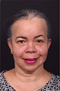 Forehead reduction hairline lowering surgery best expert near me collagen Atlanta