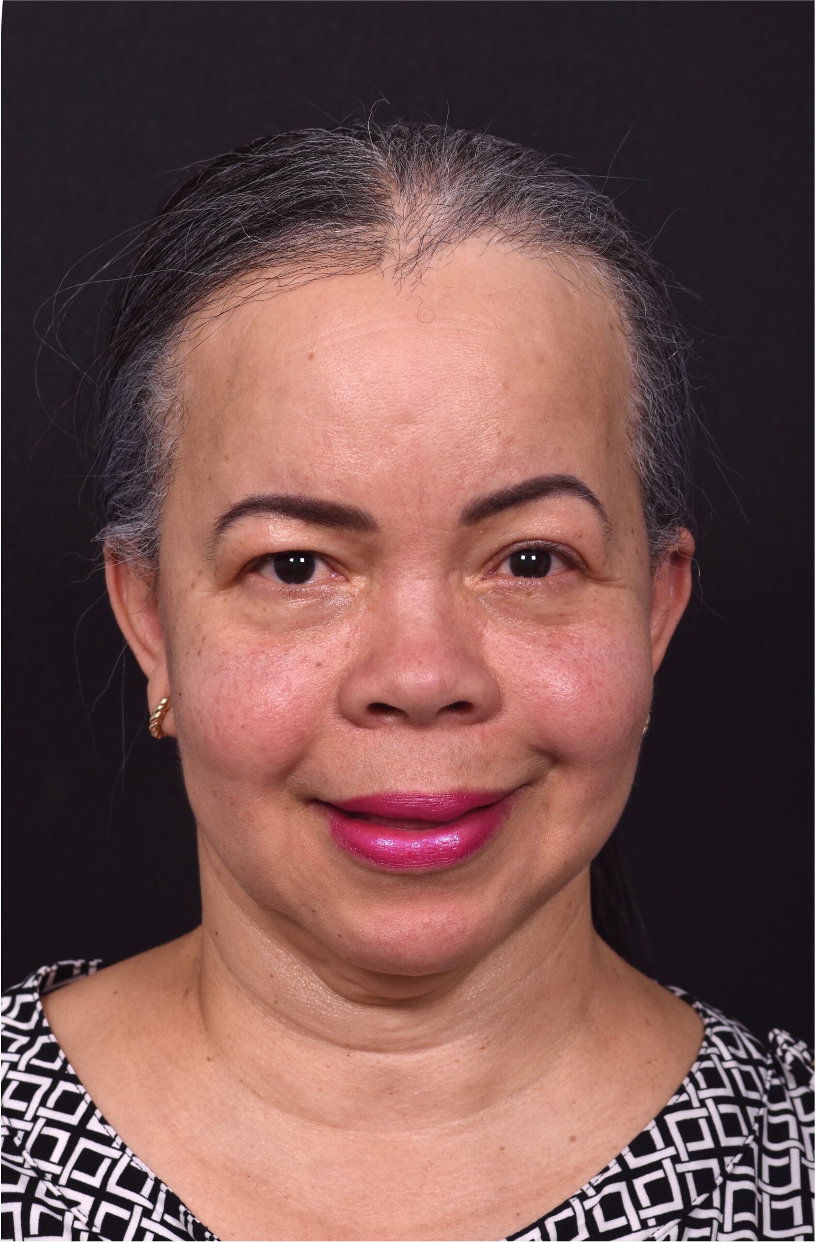 Forehead reduction hairline lowering surgery best expert near me collagen Atlanta