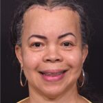 Forehead reduction hairline lowering surgery best expert near me collagen Atlanta