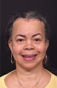 Forehead reduction hairline lowering surgery best expert near me collagen Atlanta