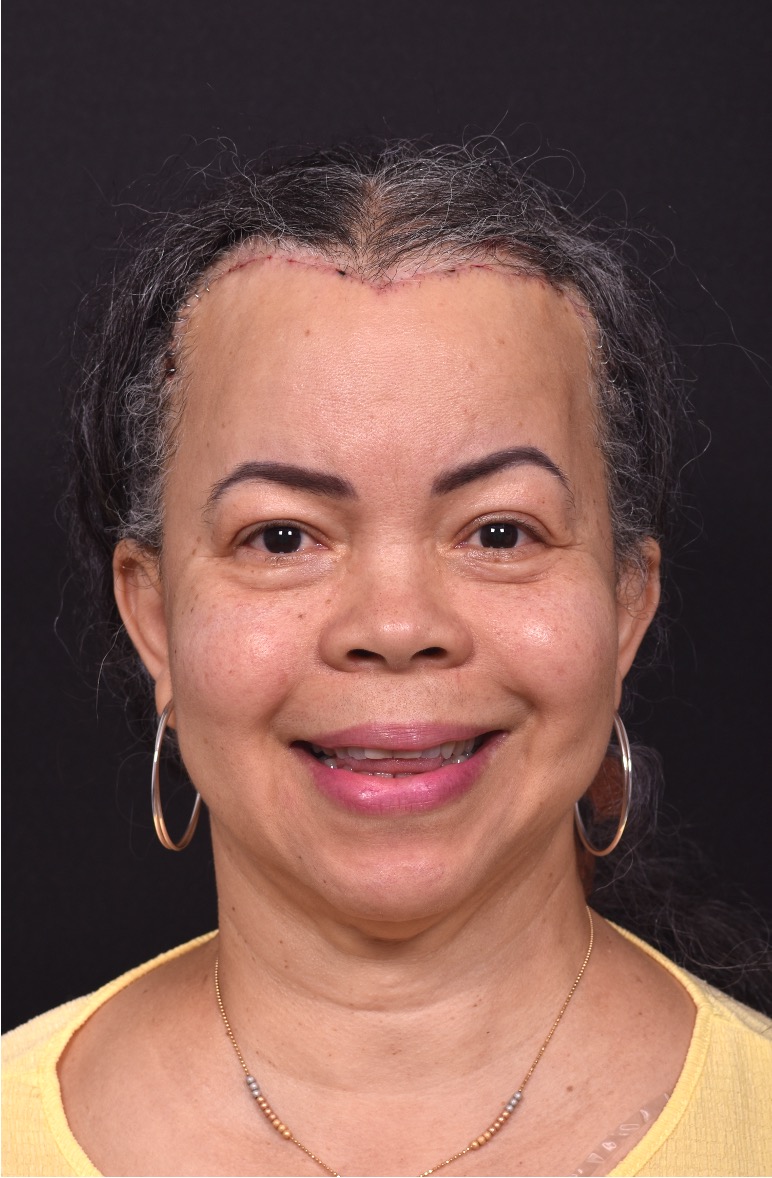 Forehead reduction hairline lowering surgery best expert near me collagen Atlanta