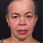 Forehead reduction hairline lowering surgery best expert near me collagen Atlanta