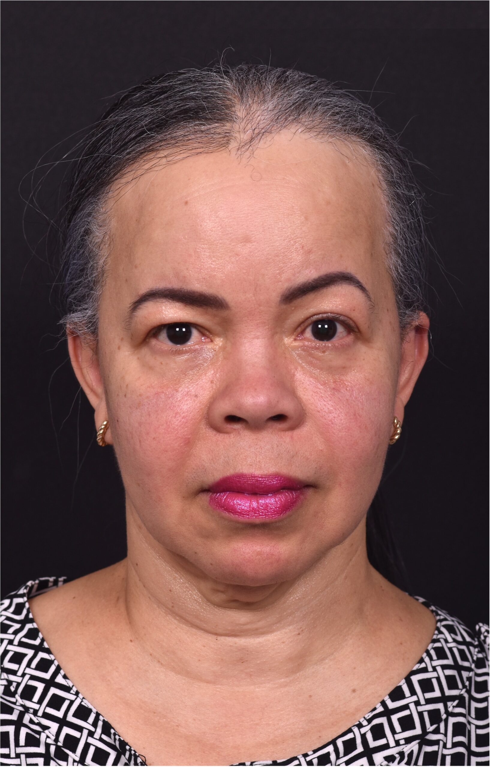 Forehead reduction hairline lowering surgery best expert near me collagen Atlanta