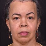 Forehead reduction hairline lowering surgery best expert near me collagen Atlanta