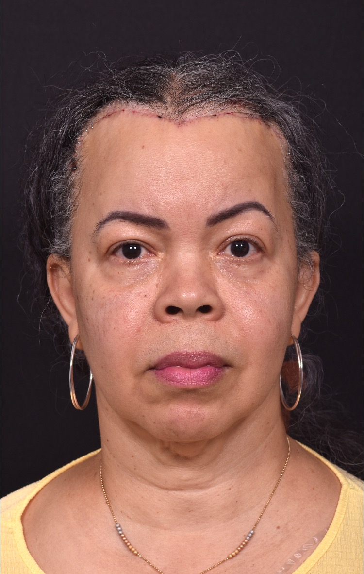 Forehead reduction hairline lowering surgery best expert near me collagen Atlanta