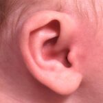 Earwell newborn ear correction baby congenital deformity before after results expert nonsurgical otoplasty
